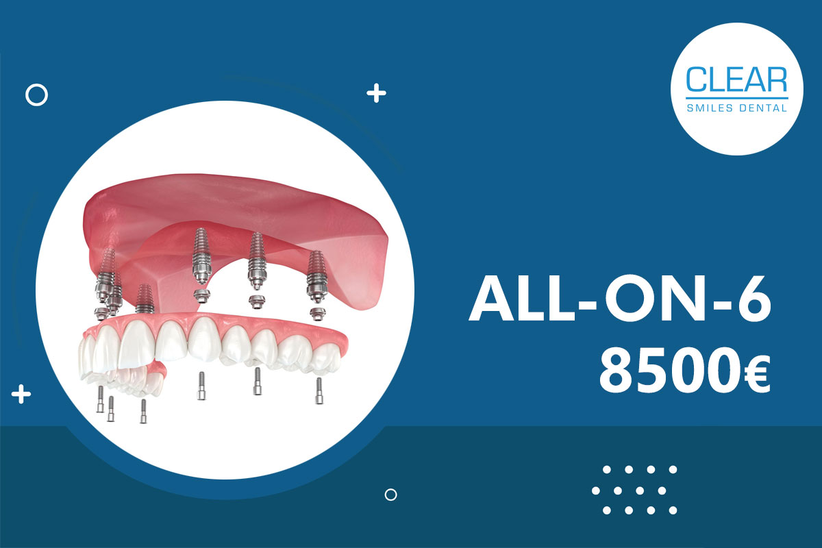 All-on-6-v55-2